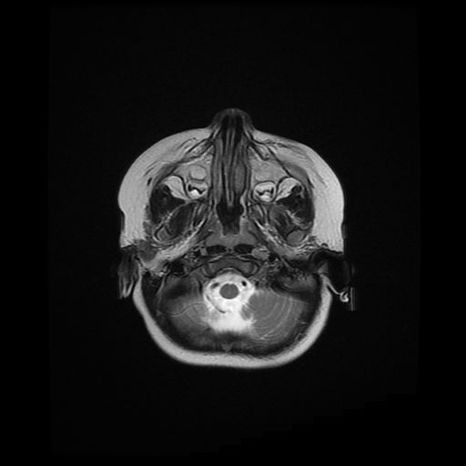File:Acute phase of hemiconvulsion-hemiplegia epilepsy syndrome (Radiopaedia 29309-29745 Axial T2 21).jpg