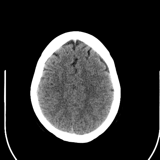 File:Acute pontine infarct from vertebral artery dissection (Radiopaedia 34111-35369 Axial non-contrast 23).png