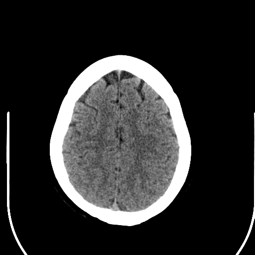 File:Acute pontine infarct from vertebral artery dissection (Radiopaedia 34111-35369 Axial non-contrast 24).png