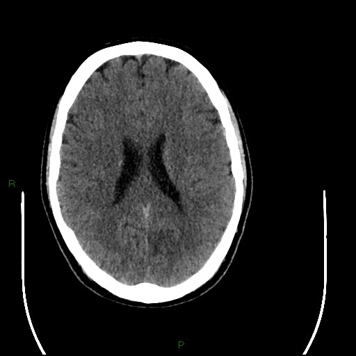 File:Acute posterior cerebral artery territory infarct (Radiopaedia 79329-92393 Axial non-contrast 66).jpg