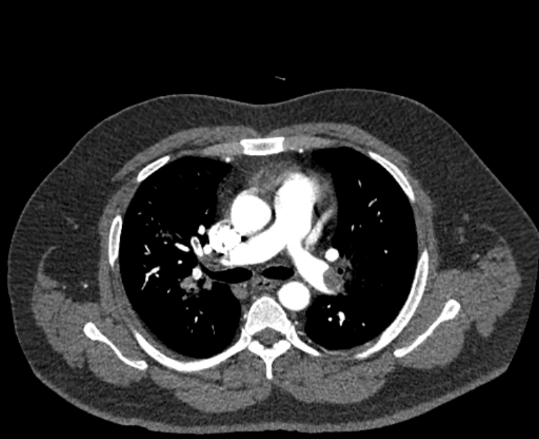 Acute pulmonary embolism with pulmonary infarcts (Radiopaedia 77688-89908 Axial C+ CTPA 25).jpg