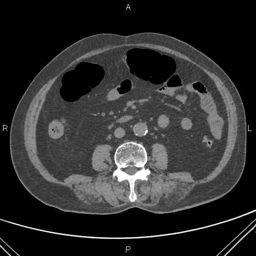 File:Acute renal artery occlusion (Radiopaedia 86586-102682 Axial non-contrast 44).jpg