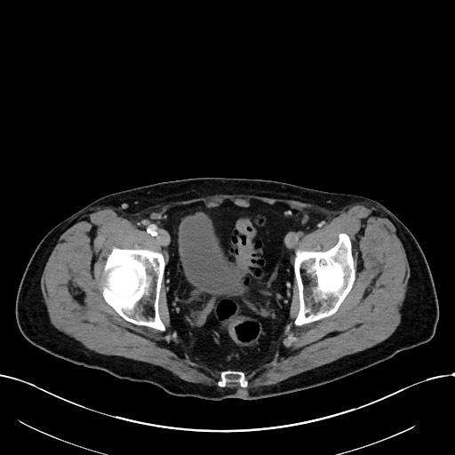 File:Acute renal infarction (Radiopaedia 59375-66736 Axial C+ portal venous phase 105).jpg
