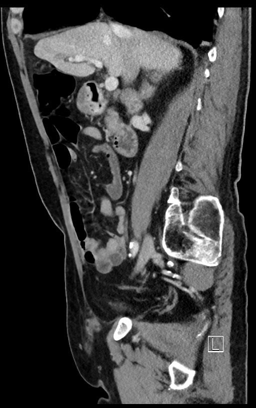 Acute renal infarction (Radiopaedia 59375-66736 Sagittal C+ portal venous phase 37).jpg