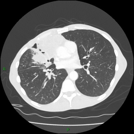 Acute right lung abscess (Radiopaedia 34806-36258 Axial lung window 104).jpg