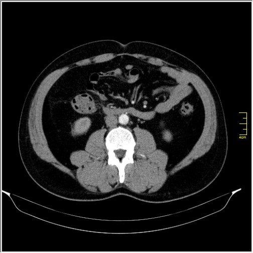 Acute right sided diverticulitis (Radiopaedia 65249-74268 Axial C+ portal venous phase 39).JPG