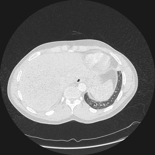 Acute segmental pulmonary emboli and pulmonary infarction (Radiopaedia 62264-70444 Axial lung window 169).jpg