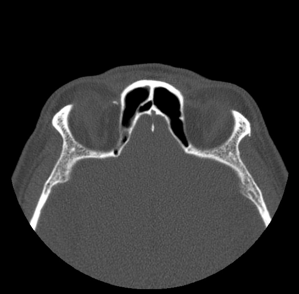 Acute sinusitis (Radiopaedia 23161-23215 Axial bone window 60).jpg