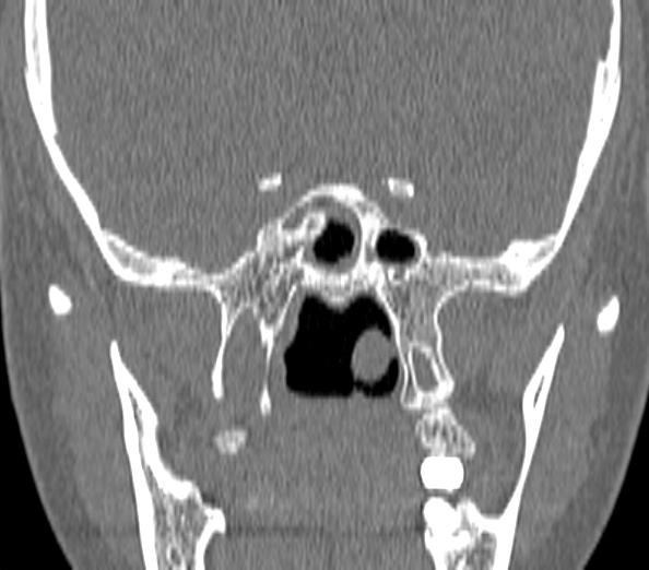 Acute sinusitis (Radiopaedia 40564-43158 Coronal bone window 37).jpg