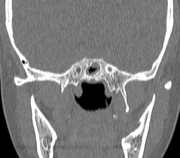 File:Acute sinusitis (Radiopaedia 40564-43158 Coronal bone window 40).jpg