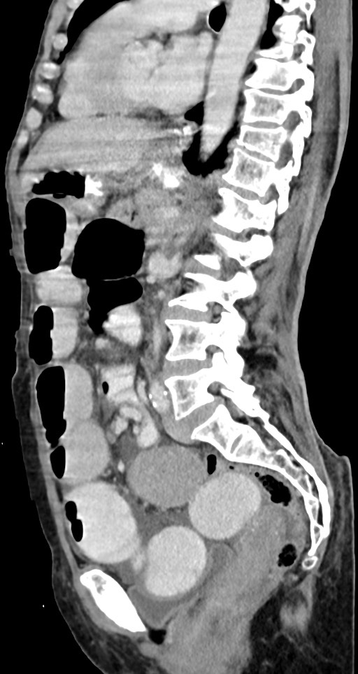 Acute small bowel (ileal) volvulus (Radiopaedia 71740-82139 Sagittal C+ portal venous phase 79).jpg