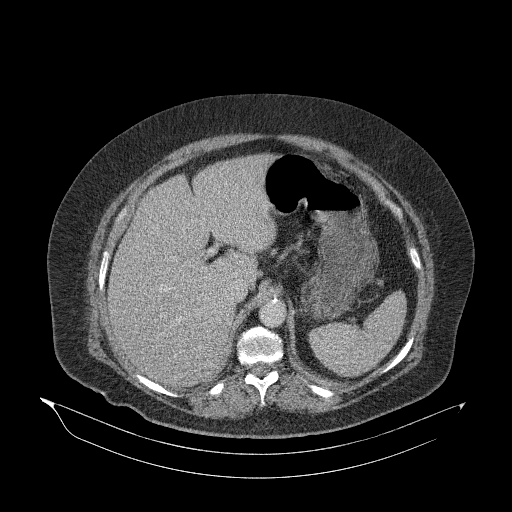 Acute superior mesenteric artery occlusion (Radiopaedia 51288-56960 Axial C+ portal venous phase 26).jpg