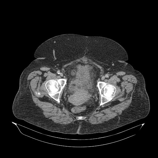File:Acute superior mesenteric artery occlusion (Radiopaedia 51288-56960 Axial C+ portal venous phase 95).jpg