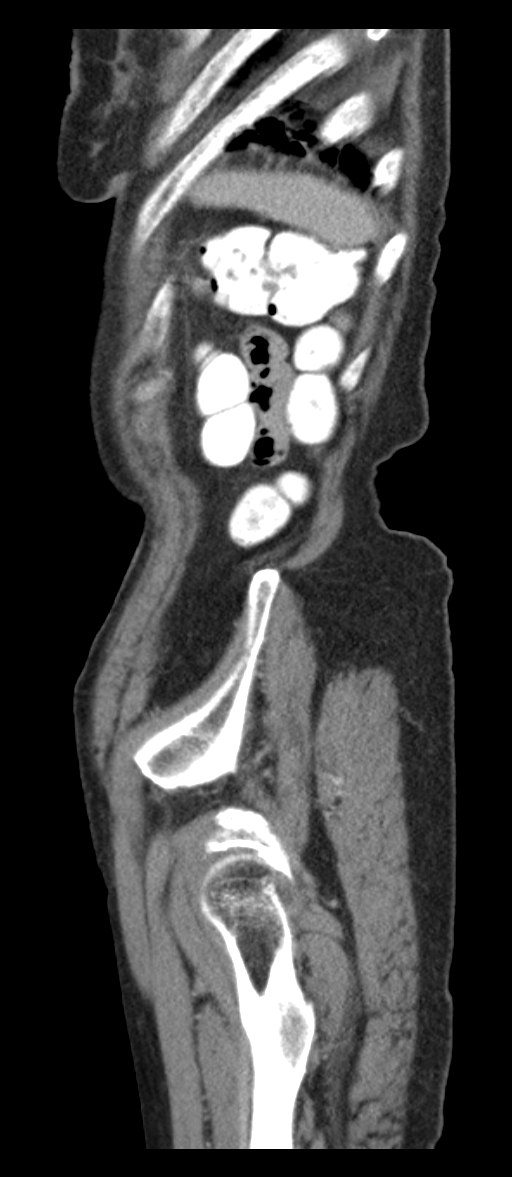 Adenocarcinoma of cecum (Radiopaedia 59222-66549 Sagittal C+ portal venous phase 1).jpg