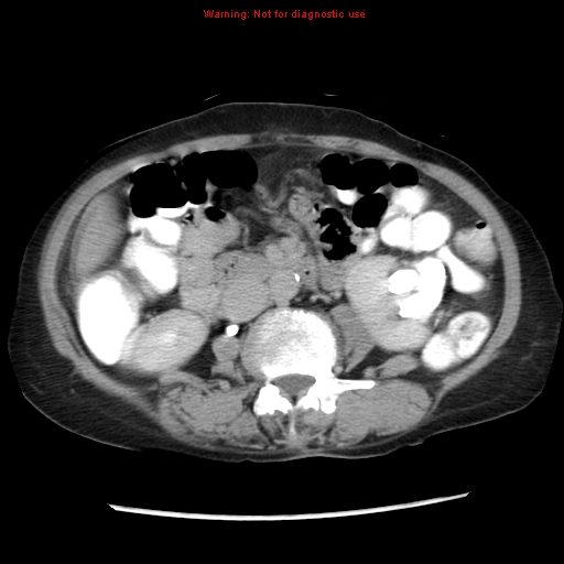 File:Adenocarcinoma of the colon (Radiopaedia 8191-9039 Axial renal excretory phase 22).jpg