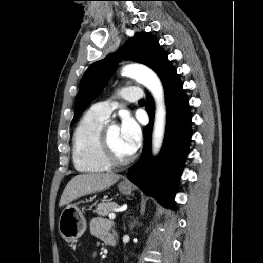 Adenocarcinoma of the lung (Radiopaedia 59871-67325 Sagittal C+ arterial phase 61).jpg