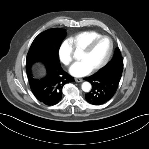 File:Adenocarcioma of rectum- T1 lesion (Radiopaedia 36921-38547 Axial C+ arterial phase 37).png