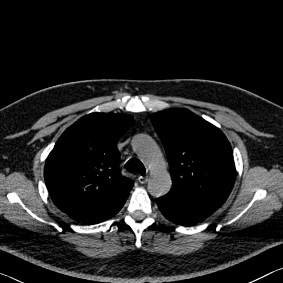 Adenoid cystic carcinoma of the trachea (Radiopaedia 49042-54137 Axial non-contrast 102).jpg