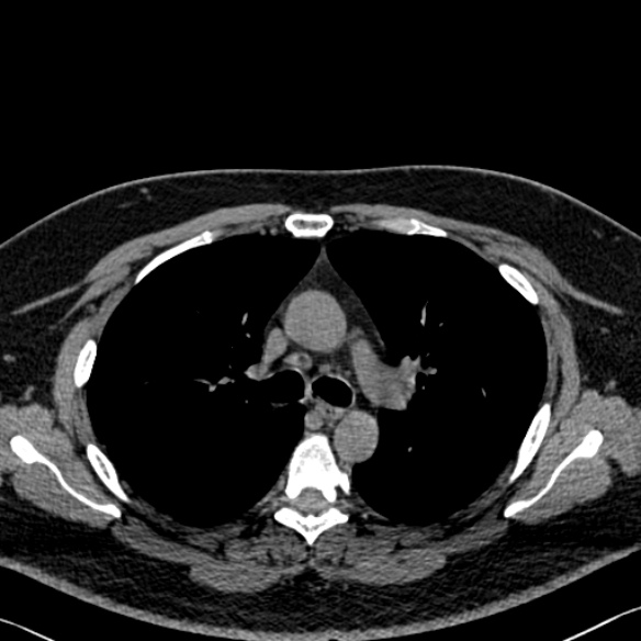 Adenoid cystic carcinoma of the trachea (Radiopaedia 49042-54137 Axial non-contrast 128).jpg