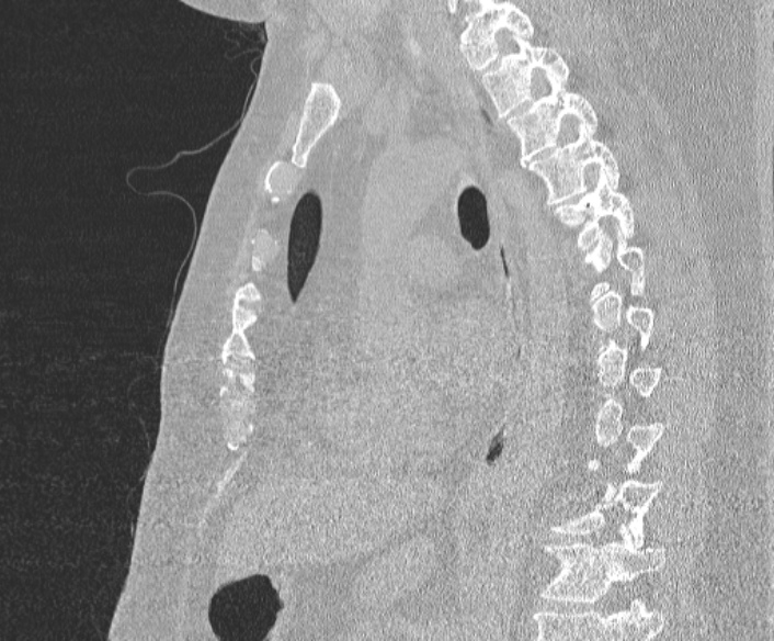 Adenoid cystic carcinoma of the trachea (Radiopaedia 49042-54137 Sagittal lung window 256).jpg