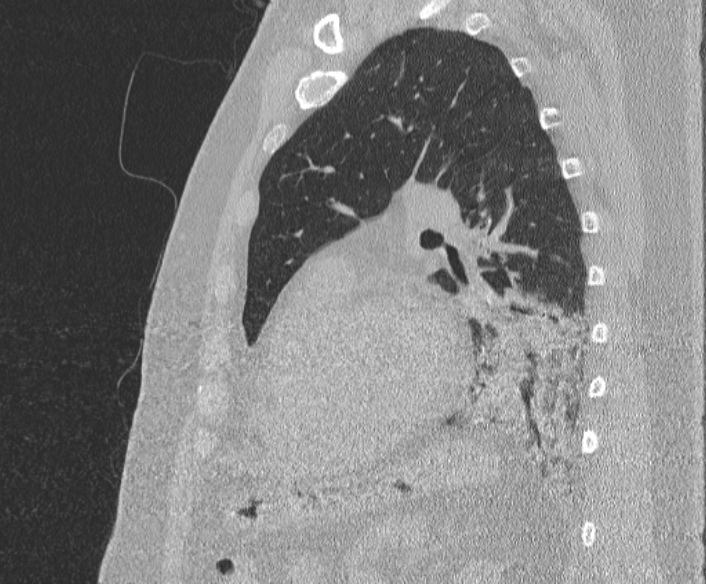 File:Adenoid cystic carcinoma of the trachea (Radiopaedia 49042-54137 Sagittal lung window 306).jpg