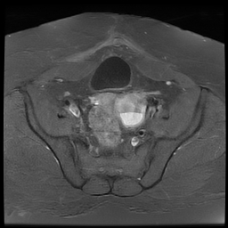 File:Adenomyosis within a didelphys uterus (Radiopaedia 70175-80215 Axial T1 C+ fat sat 22).jpg