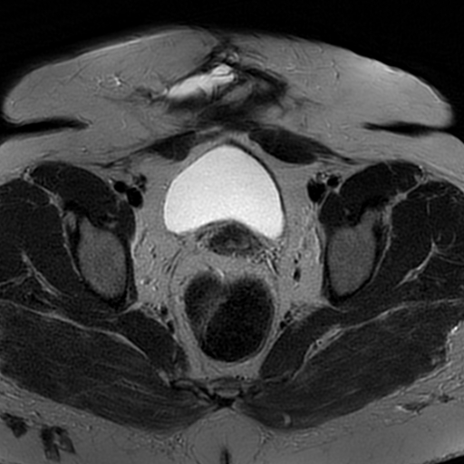 File:Adenomyosis within a didelphys uterus (Radiopaedia 70175-80215 Axial T2 22).jpg