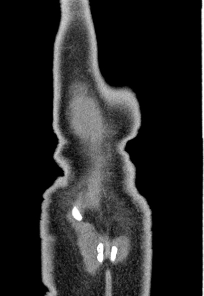 Adhesional small bowel obstruction (Radiopaedia 52107-57980 Coronal C+ portal venous phase 80).jpg
