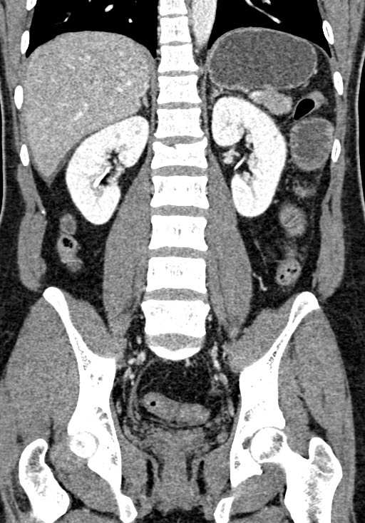 Adhesional small bowel obstruction (Radiopaedia 58900-66131 Coronal C+ portal venous phase 169).jpg