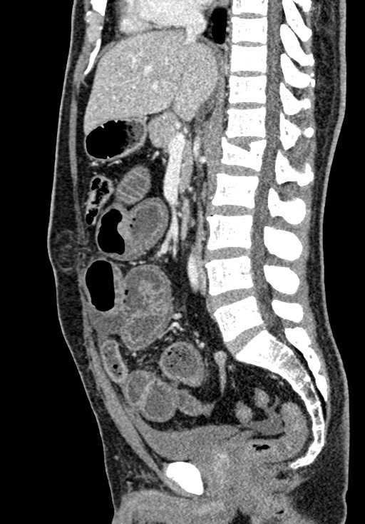 Adhesional small bowel obstruction (Radiopaedia 58900-66131 Sagittal C+ portal venous phase 122).jpg