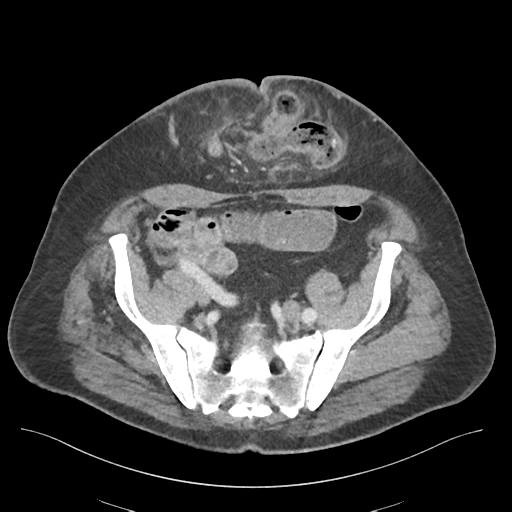File:Adhesions within abdominal wall hernia (Radiopaedia 58283-65394 Axial C+ portal venous phase 65).png