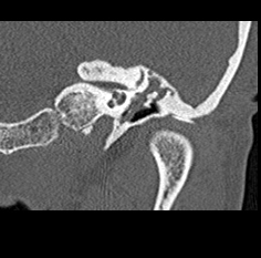 File:Adhesive chronic otitis media (Radiopaedia 14270-14148 Coronal bone window - left 11).jpg