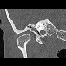 File:Adhesive chronic otitis media (Radiopaedia 14270-14148 Coronal bone window - right 5).jpg