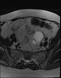 File:Adnexal multilocular cyst (O-RADS US 3- O-RADS MRI 3) (Radiopaedia 87426-103754 Axial T2 6).jpg