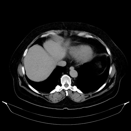 Adrenal cortical carcinoma (Radiopaedia 64017-72769 Axial C+ delayed 10).jpg