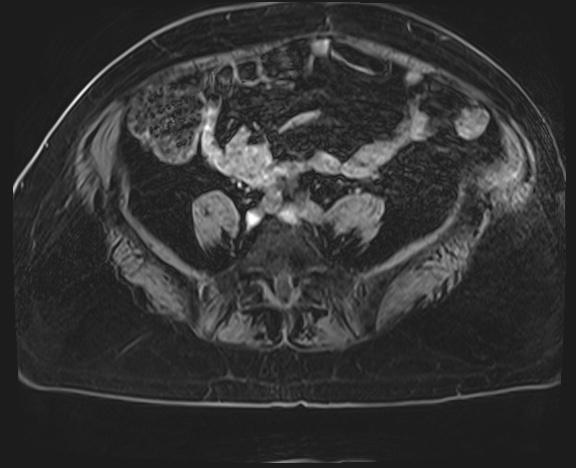 Adrenal cortical carcinoma (Radiopaedia 64017-72770 H 63).jpg