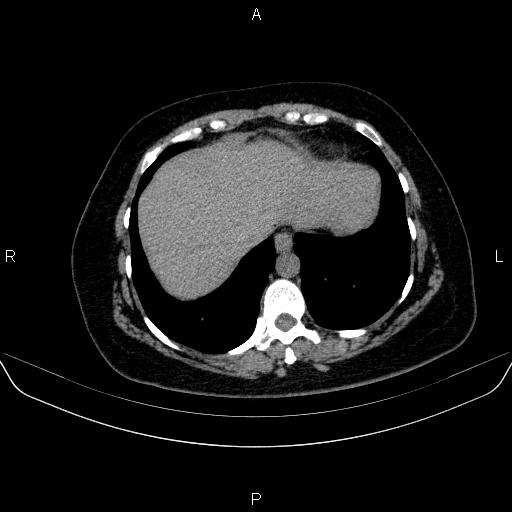File:Adrenal cortical carcinoma (Radiopaedia 84882-100379 Axial non-contrast 11).jpg