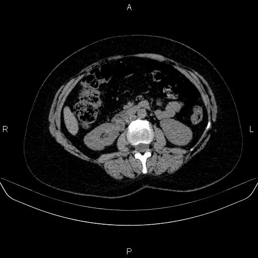 File:Adrenal cortical carcinoma (Radiopaedia 84882-100379 Axial non-contrast 42).jpg