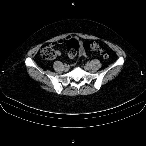 File:Adrenal cortical carcinoma (Radiopaedia 84882-100379 Axial non-contrast 69).jpg