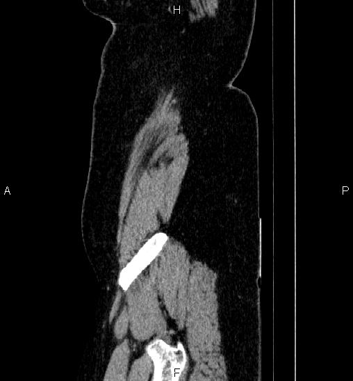 Adrenal cortical carcinoma (Radiopaedia 84882-100379 Sagittal C+ portal venous phase 4).jpg
