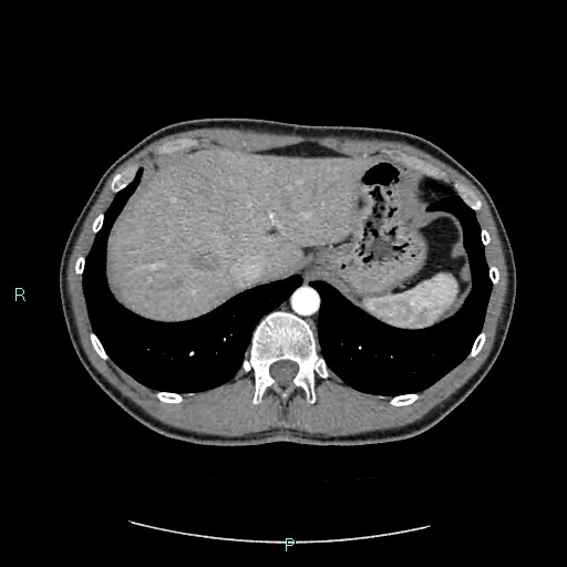 Adrenal cystic lymphangioma (Radiopaedia 83161-97534 Axial C+ arterial phase 18).jpg