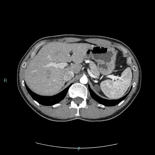 Adrenal cystic lymphangioma (Radiopaedia 83161-97534 Axial C+ arterial phase 25).jpg