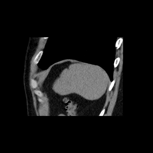 Adrenal gland trauma (Radiopaedia 81351-95079 Sagittal non-contrast 89).jpg