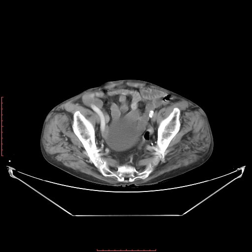 File:Adrenal hemangioma (Radiopaedia 68923-78668 Axial C+ portal venous phase 60).jpg