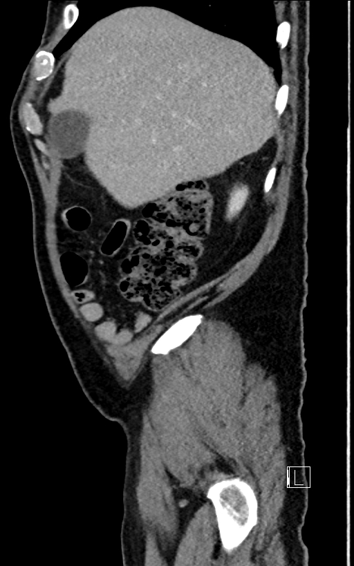 Adrenal lymphoma (Radiopaedia 73730-84529 Sagittal C+ portal venous phase 17).jpg
