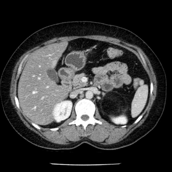 Adrenal myelolipoma (Radiopaedia 43401-46759 Axial C+ portal venous phase 29).jpg