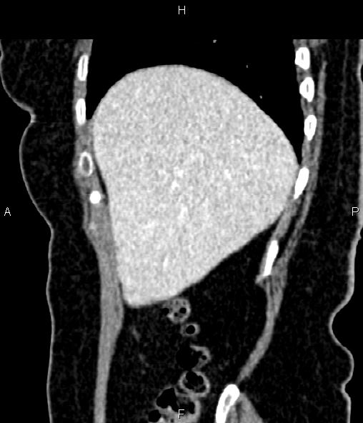 Adrenal myelolipoma (Radiopaedia 82742-96986 Sagittal renal cortical phase 24).jpg