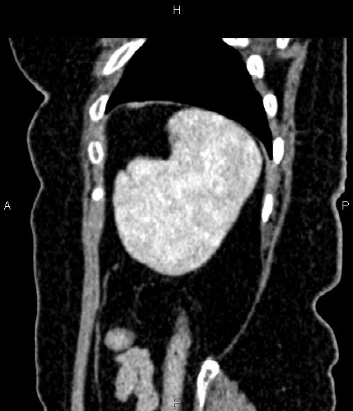 Adrenal myelolipoma (Radiopaedia 82742-96986 Sagittal renal cortical phase 91).jpg