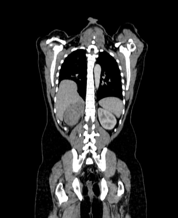 Adrenocortical carcinoma (Radiopaedia 80134-93438 Coronal C+ portal venous phase 122).jpg