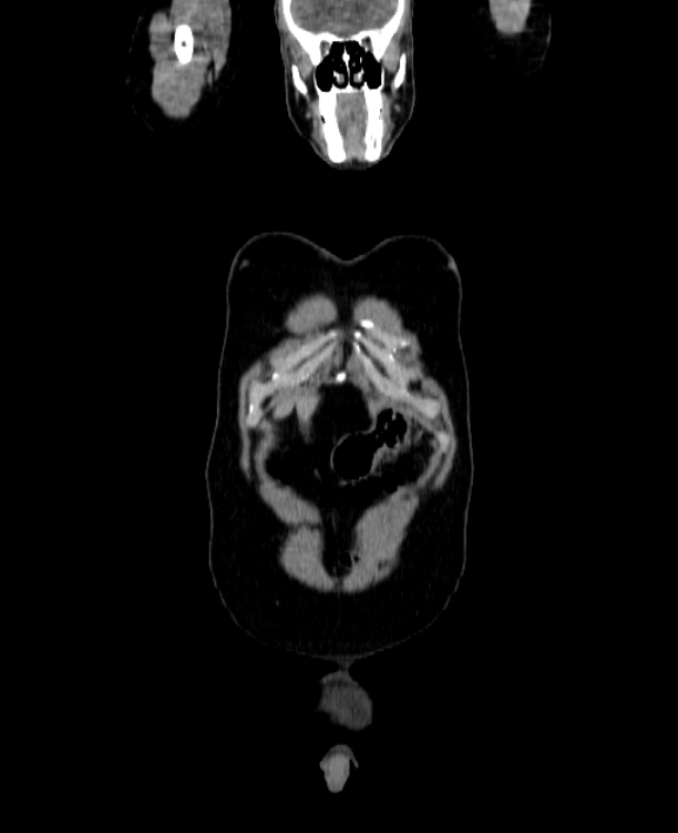 Adrenocortical carcinoma (Radiopaedia 80134-93438 Coronal C+ portal venous phase 18).jpg